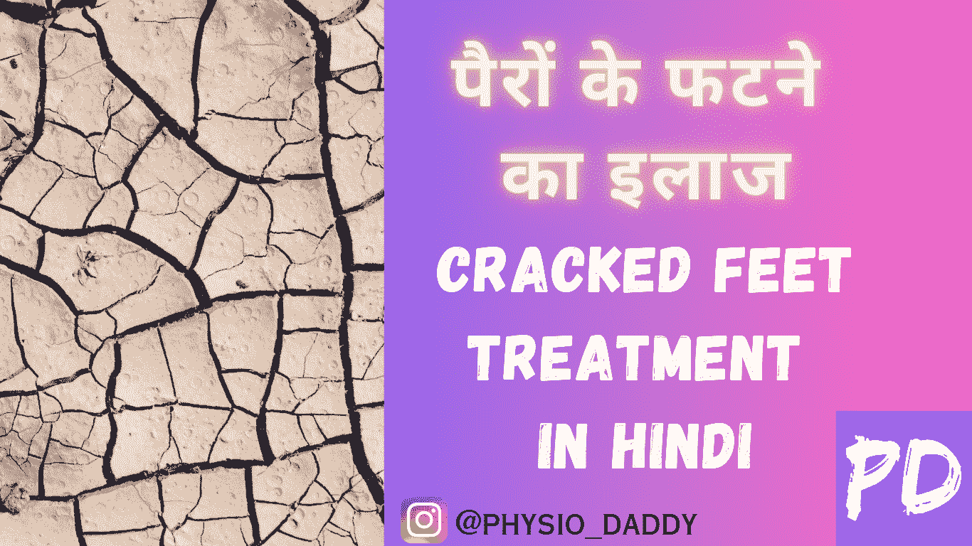 पैरों के फटने का इलाज - cracked feet treatment in hindi