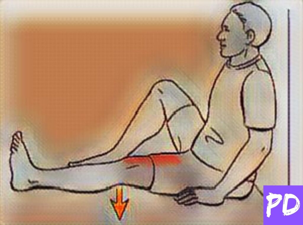 Quad Sets exercise for ACL injury 