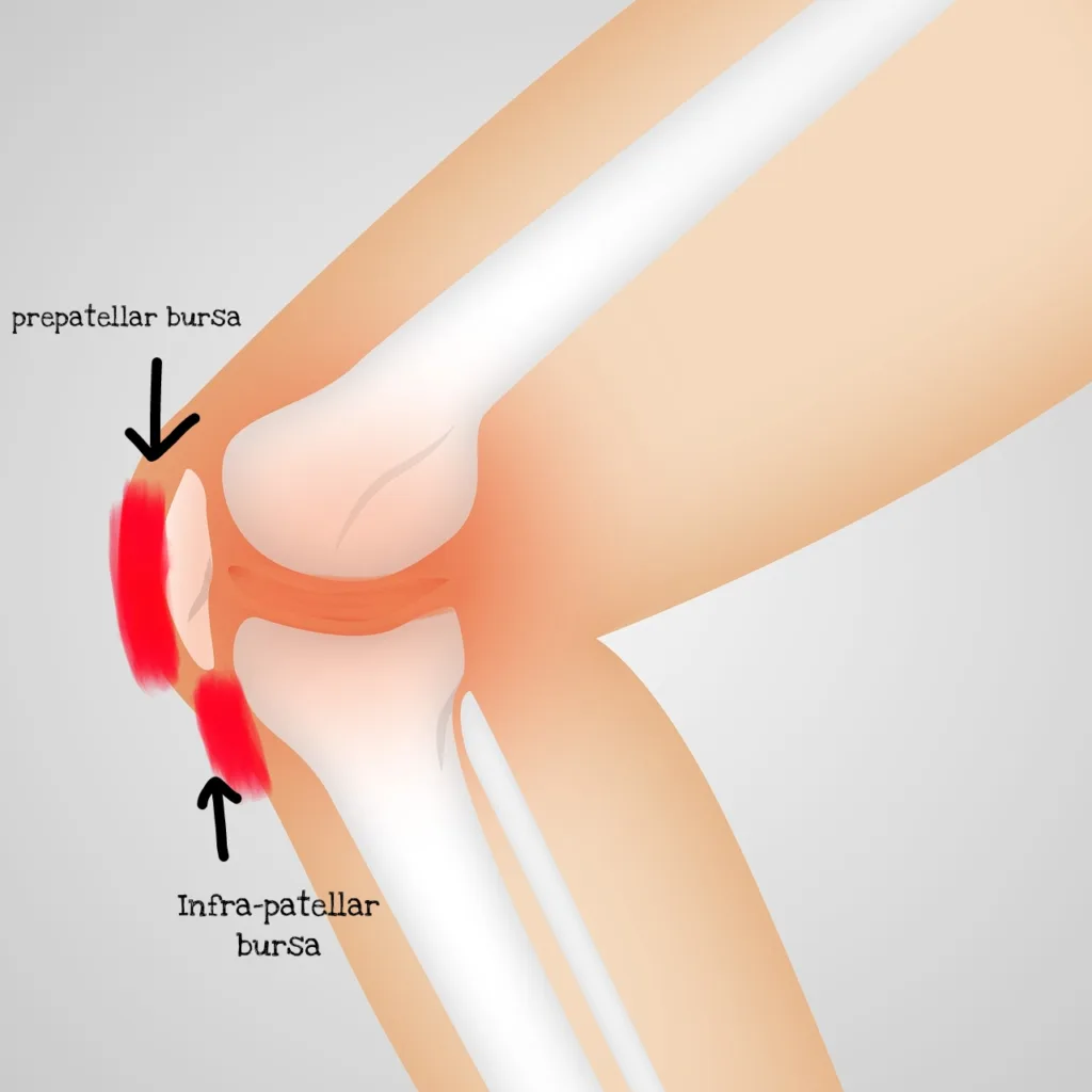 बर्साइटिस - Bursitis.
घुटने से नीचे पैर में दर्द होने का कारण - causes of leg pain below knee in hindi