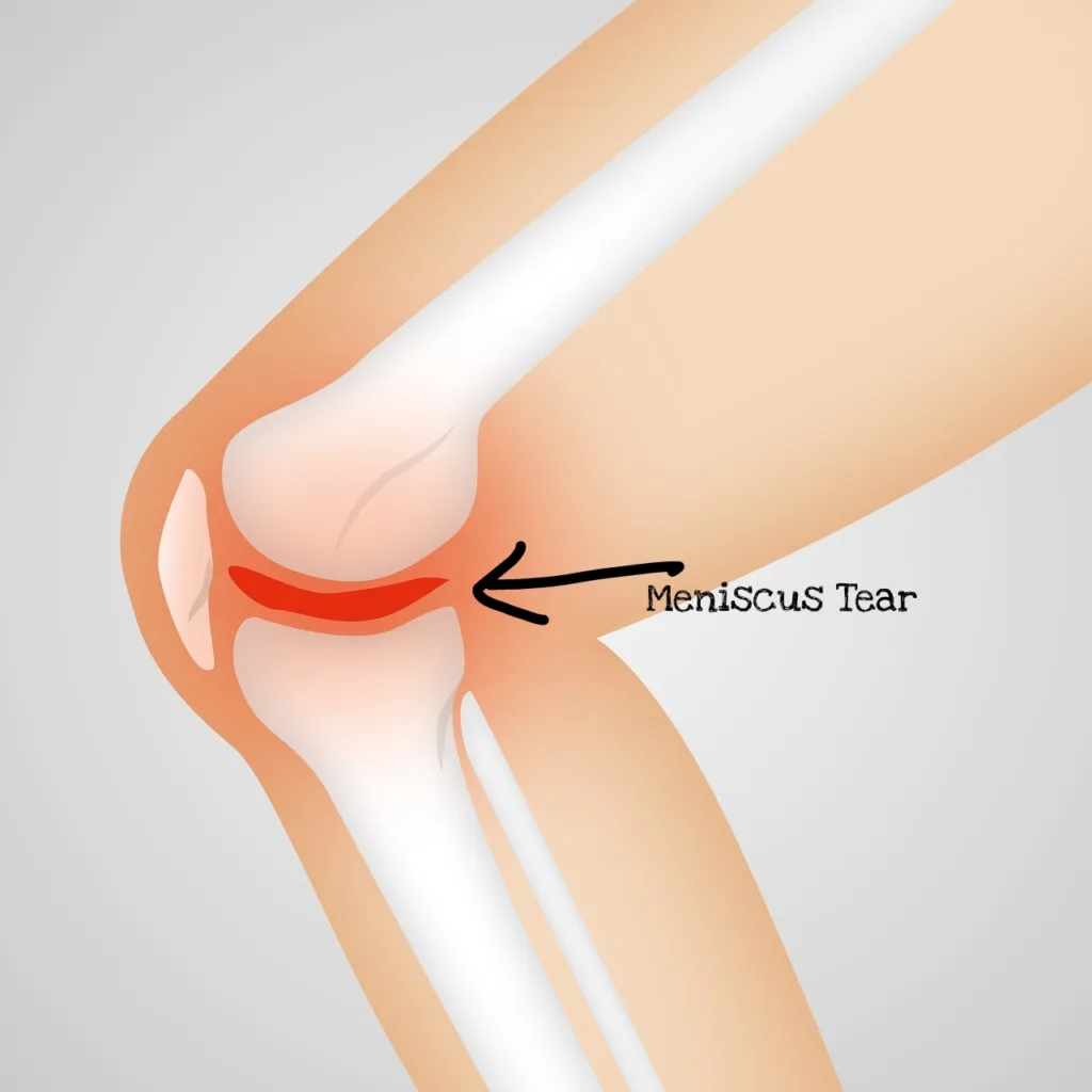 मिनिस्कस टियर - Meniscus Tear.
घुटने से नीचे पैर में दर्द होने का कारण - causes of leg pain below knee in hindi