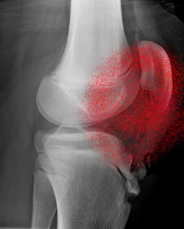 Patellofemoral Pain Syndrome. घुटने से नीचे पैर में दर्द होने का कारण - causes of leg pain below knee in hindi