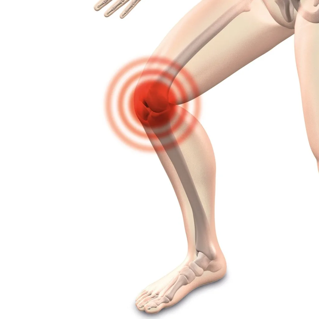 ऑस्टियोआर्थराइटिस - Osteoarthritis.
घुटने से नीचे पैर में दर्द होने का कारण - causes of leg pain below knee in hindi